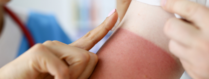 workers compensation for sunburn injury