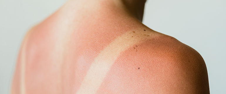 workers compensation for sunburn injury