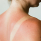 workers compensation for sunburn injury